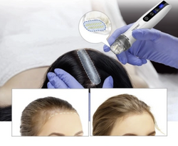 Bio Pen Q2 – 4-in-1 Microneedling Pen with EMS, LED Light Therapy & MTS + 2 Cartridges