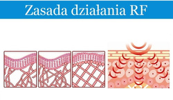 Radio Frequency Radio MINI RF Lifting Wrinkles Cellulite